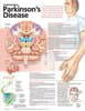 Understanding Parkinson's Disease Anatomical Chart