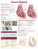 Heart Failure Anatomical Chart