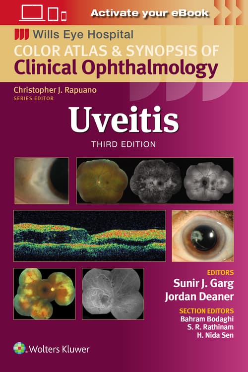 Uveitis