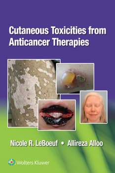 Cutaneous Toxicities from Anticancer Therapies