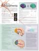 Understanding Schizophrenia Anatomical Chart