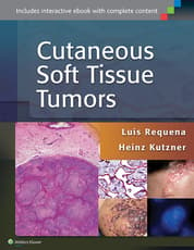 Cutaneous Soft Tissue Tumors