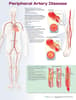 Peripheral Artery Disease Anatomical Chart