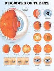 Disorders of the Eye Anatomical Chart