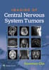 Imaging of CNS Tumors