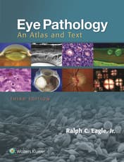 Eye Pathology