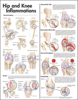 Hip and Knee Inflammations Anatomical Chart