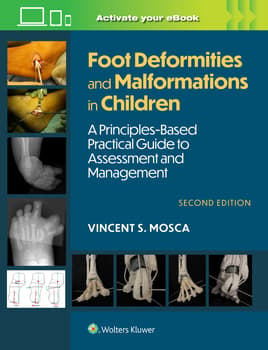 Foot Deformities and Malformations in Children