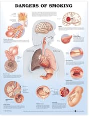 Dangers of Smoking Anatomical Chart